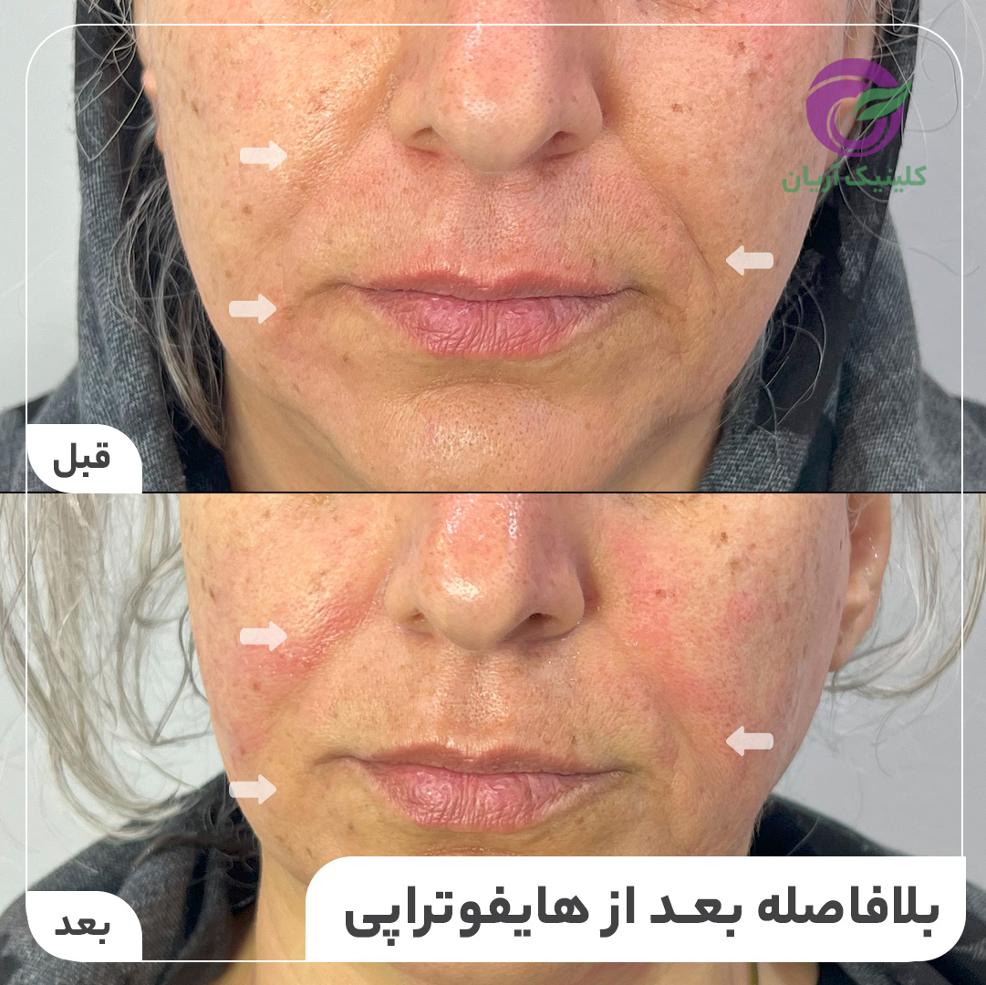 گالری هایفوتراپی